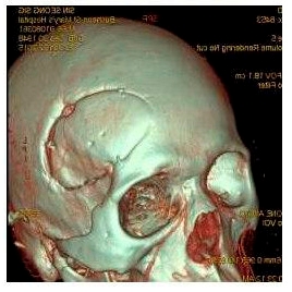 Классическая краниотомия (трепанация черепа) — после такой операции сильно повреждаются череп, нужно полностью брить голову, придется восстанавливаться от месяца до полугода
