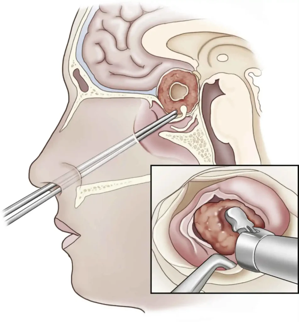 Medmost | Рак гипофиза Рак гипофиза