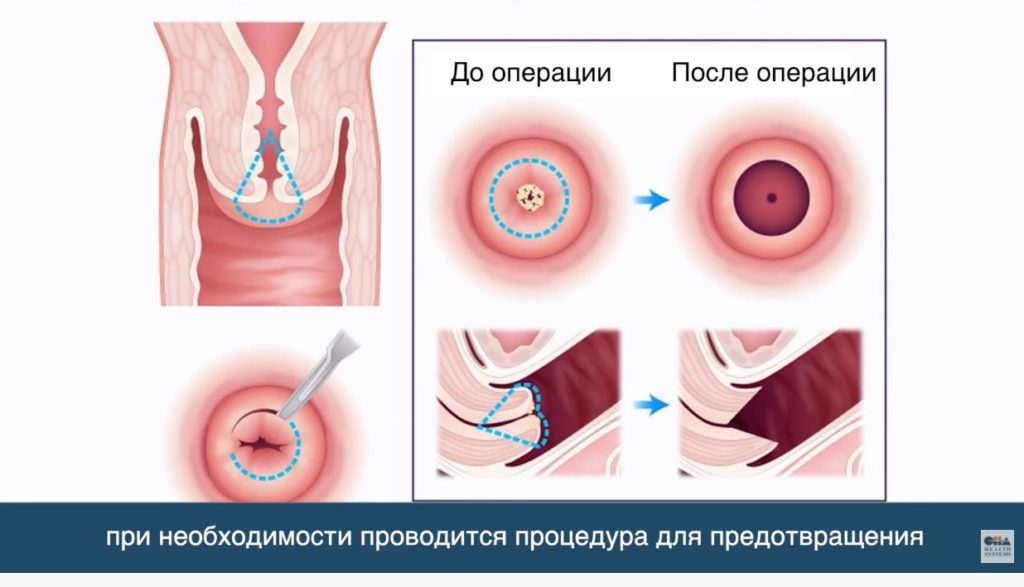 Лечение рака шейки матки в Корее. Интервью корейского врача