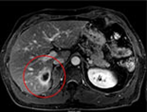 метастаз рака кишечника в печени МРТ после лечения киберножом