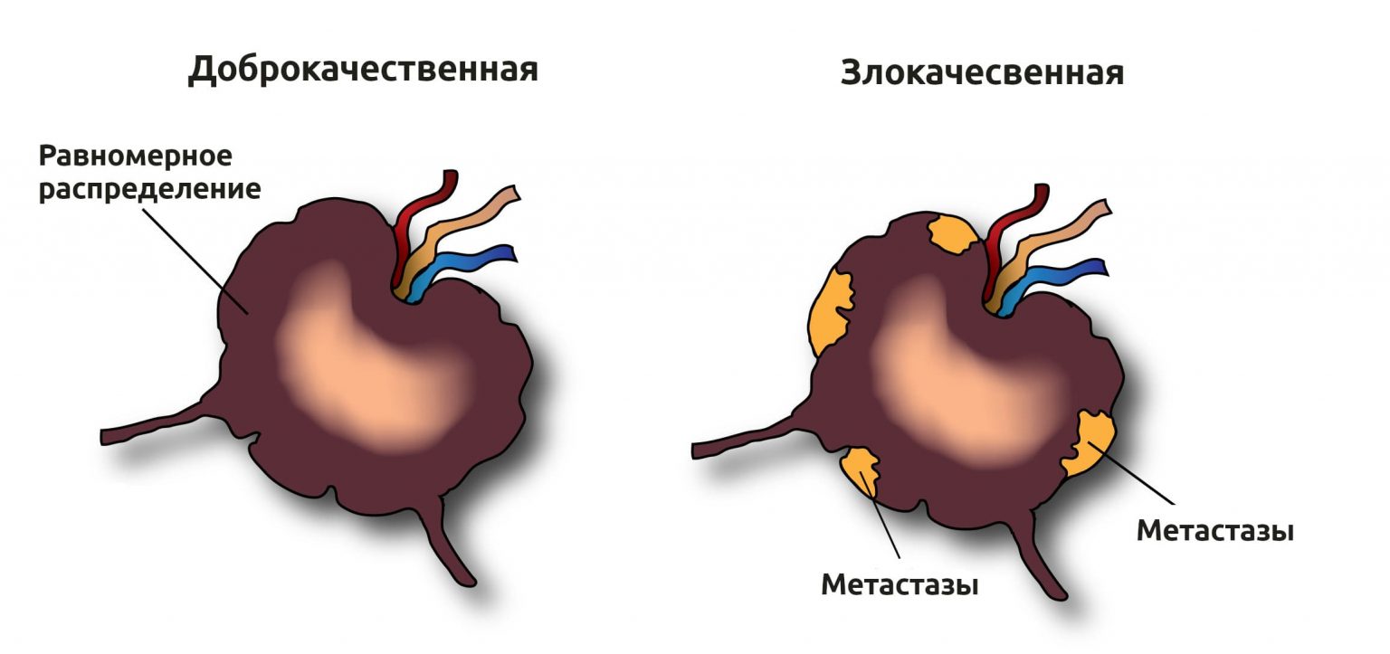 Рак лимфоузлов симптомы фото