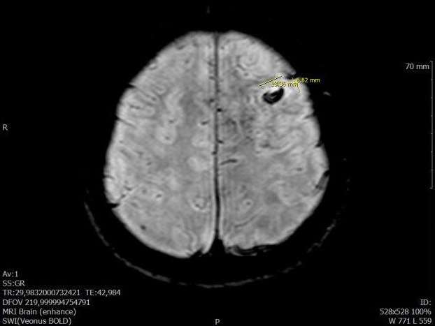 Лечение рака головного мозга в Корее medmost.org На МРТ видно черное пятно в правом полушарии мозга — это кавернома