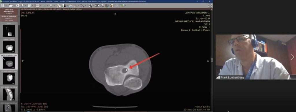 Онлайн-консультация израильского ортопеда по травме локтя КТ видно опухоль