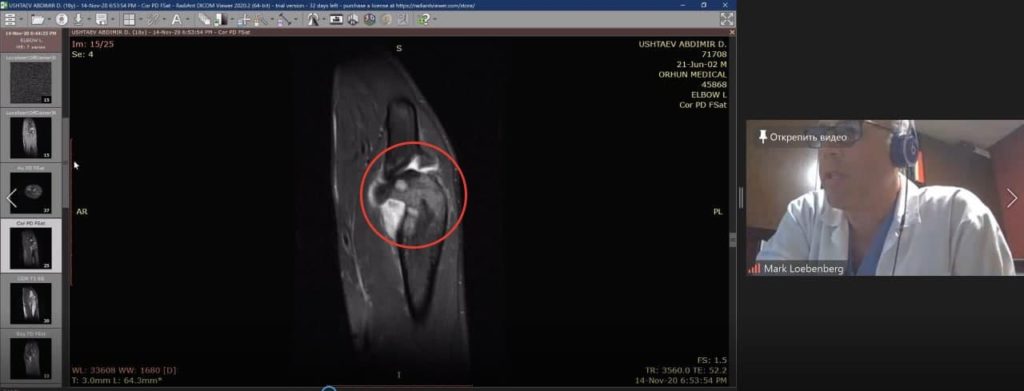 Онлайн-консультация израильского ортопеда по травме локтя МРТ видно синовит и опухоль