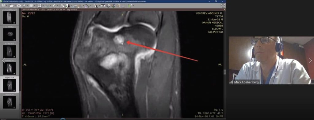 Онлайн-консультация израильского ортопеда по травме локтя МРТ видно синовит и опухоль с другой проекции