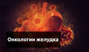 Рак желудка: первые симптомы, признаки у женщин и мужчин