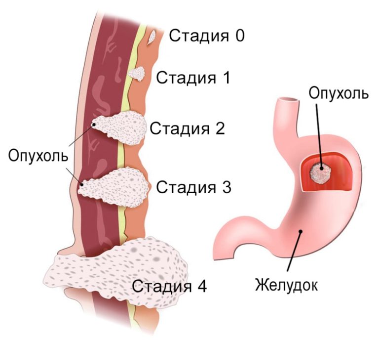 Что такое рак