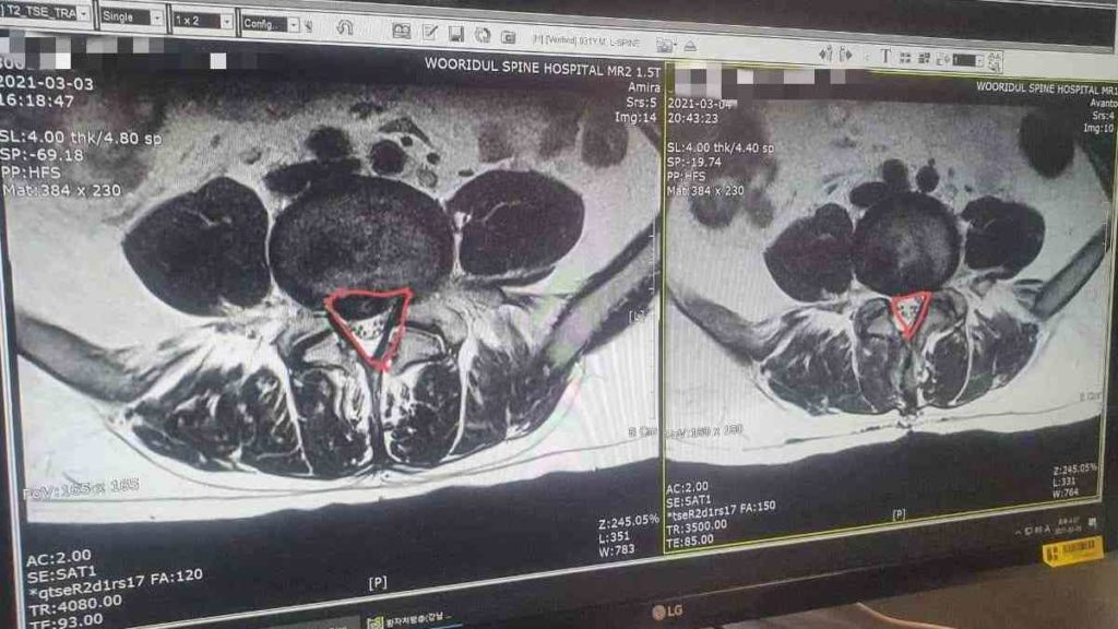 Снимок до и после операции. Слева есть межпозвоночная грыжа, справа её уже нет