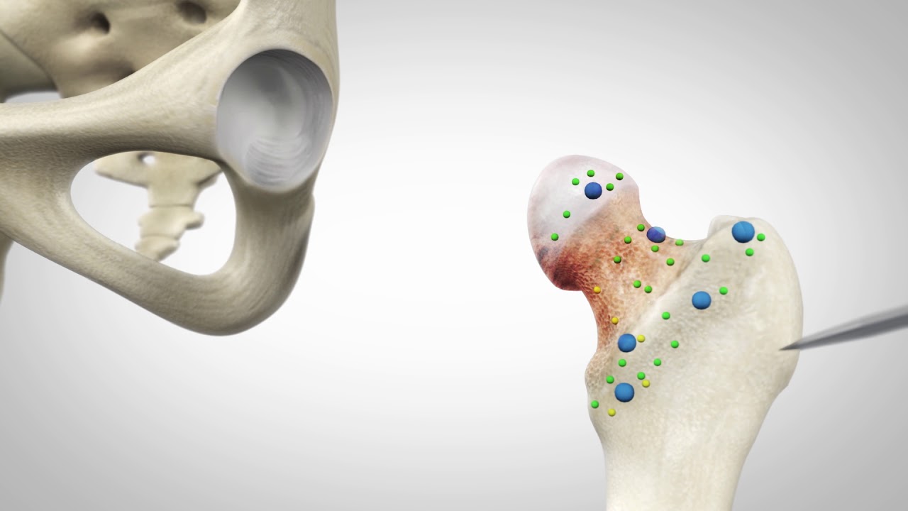 Medmost | Эндопротезирование тазобедренного сустава за границей: выбор больницы и стоимость лечения Эндопротезирование тазобедренного сустава за границей: выбор больницы и стоимость лечения
