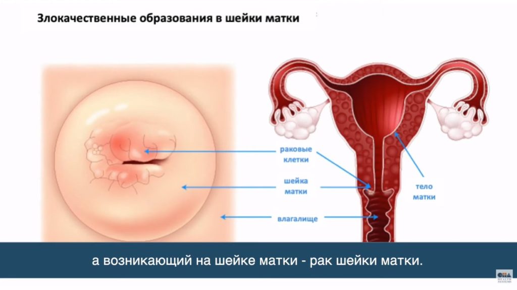 Лечение рака шейки матки в Корее. Интервью корейского врача