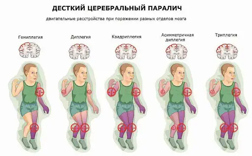 Medmost | Методы реабилитации ДЦП с доказанной эффективностью Методы реабилитации ДЦП с доказанной эффективностью