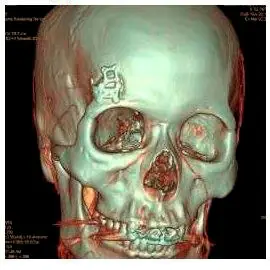 Medmost | Отзыв пациента: лечение опухоли головного мозга в Корее Плюс хирургии замочной скважины в том, что минимально травмируется череп, не нужно полностью брить голову и восстанавливаться после лечения занимает неделю