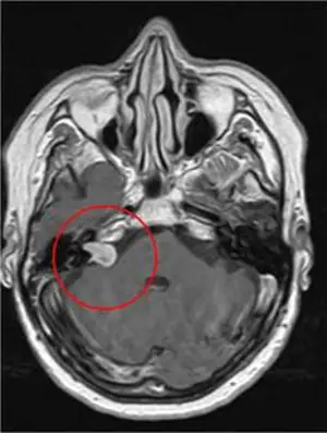 Medmost | Лечение киберножом за границей: радиохирургия в онкологии и нейрохирургии, насколько это безопасно, как проходит лечение Акустичекая невринома до лечения киберножом