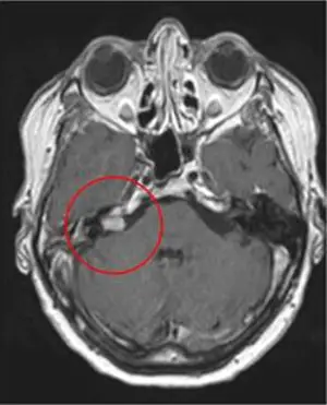 Medmost | Лечение киберножом за границей: радиохирургия в онкологии и нейрохирургии, насколько это безопасно, как проходит лечение Акустичекая невринома после лечения киберножом
