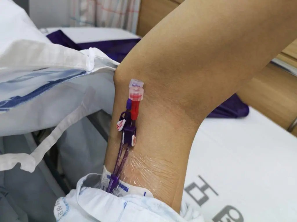 Medmost | Отзыв пациента: лечение опухоли головного мозга в Корее Поставили силиконовый катетер, чтобы каждый раз заново не колоть вены