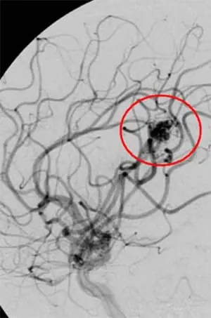 Medmost | Лечение киберножом за границей: радиохирургия в онкологии и нейрохирургии, насколько это безопасно, как проходит лечение церебральная артериовенозная мальформация до лечения киберножом