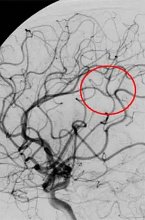 Medmost | Лечение киберножом за границей: радиохирургия в онкологии и нейрохирургии, насколько это безопасно, как проходит лечение церебральная артериовенозная мальформация после лечения киберножом