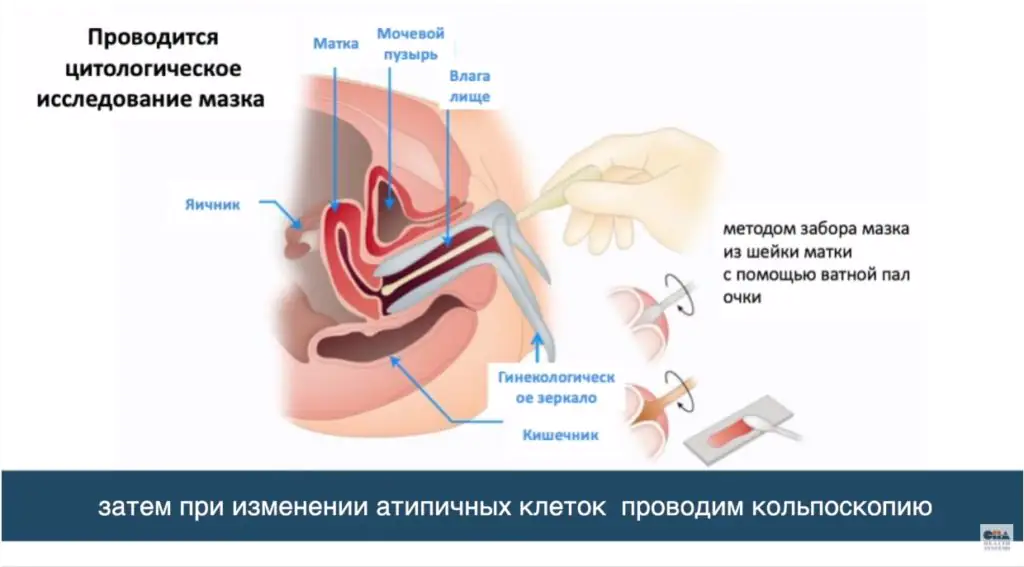 Medmost | Лечение рака шейки матки в Корее. Интервью корейского врача Лечение рака шейки матки в Корее. Интервью корейского врача