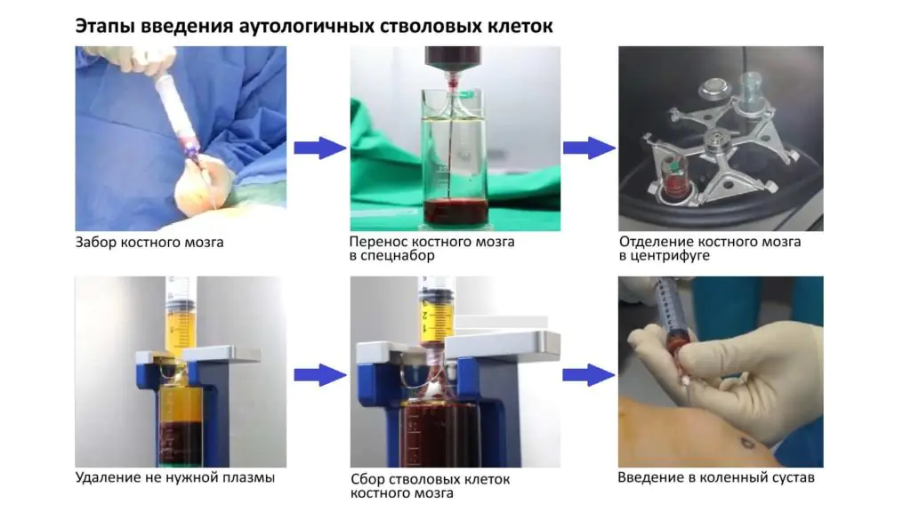 Medmost | Лечения артрита и артроза коленного сустава стволовыми клетками Этапы введения аутологичных стволовых клеток для лечения артроза и артрита