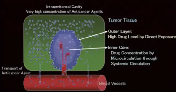 Medmost | Лечение канцероматоза в Корее методом HIPEC и LHIPEC Концентрация химиопрепарата при внутрибрюшной химиотерапии