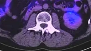 Medmost | Лечение киберножом за границей: радиохирургия в онкологии и нейрохирургии, насколько это безопасно, как проходит лечение метастаз почечно-клеточного рака в позвоночном столбе после лечения киберножом