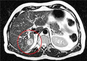 Medmost | Лечение киберножом за границей: радиохирургия в онкологии и нейрохирургии, насколько это безопасно, как проходит лечение Лечение киберножом за границей: радиохирургия в онкологии и нейрохирургии, насколько это безопасно, как проходит лечение