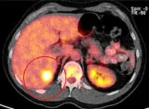Medmost | Лечение киберножом за границей: радиохирургия в онкологии и нейрохирургии, насколько это безопасно, как проходит лечение метастаз рака кишечника в печени ПЭТКТ до лечения киберножом