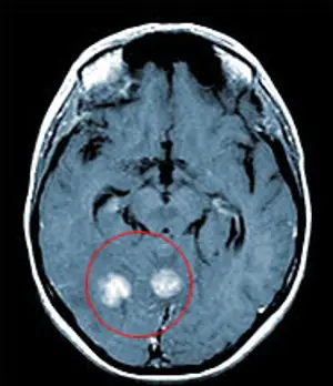 Medmost | Лечение киберножом за границей: радиохирургия в онкологии и нейрохирургии, насколько это безопасно, как проходит лечение м