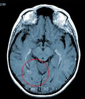 Medmost | Лечение киберножом за границей: радиохирургия в онкологии и нейрохирургии, насколько это безопасно, как проходит лечение Лечение киберножом за границей: радиохирургия в онкологии и нейрохирургии, насколько это безопасно, как проходит лечение