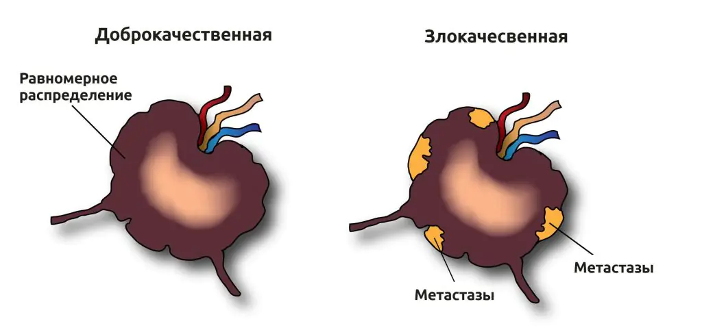 Medmost | Рак лимфоузлов: Первые симптомы и прогноз при метастазах Метастазы в лимфатических узлах