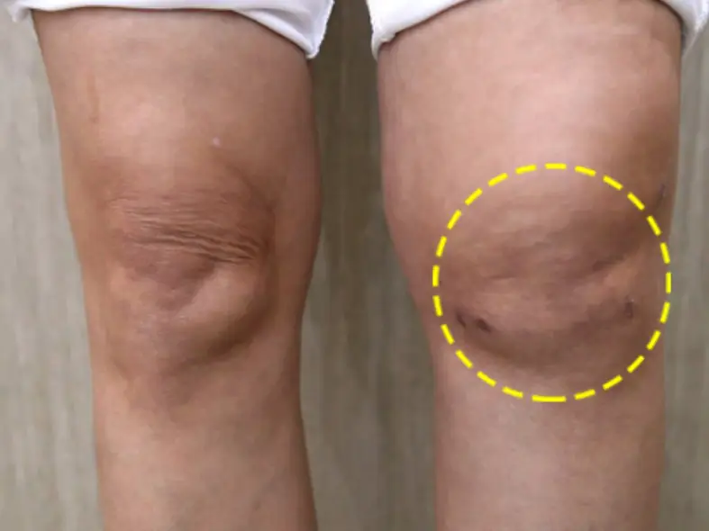 Medmost | Лечения артрита и артроза коленного сустава стволовыми клетками Минимальные шрамы после регенерации стволовыми клетками Caristem неинвазивным методом