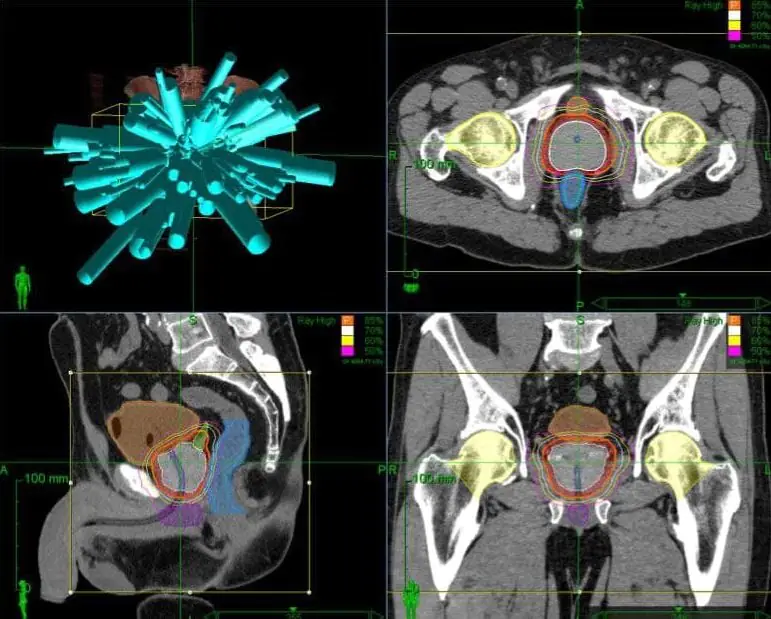 Medmost | Лечение киберножом за границей: радиохирургия в онкологии и нейрохирургии, насколько это безопасно, как проходит лечение Облучение рака простаты киберножом