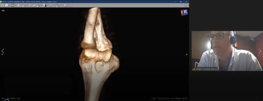 Medmost | Два года болел локоть. В Казахстане ставили компрессионный перелом, а израильский ортопед на онлайн-консультации нашел истинную причину болей Онлайн-консультация израильского ортопеда по травме локтя кт модель