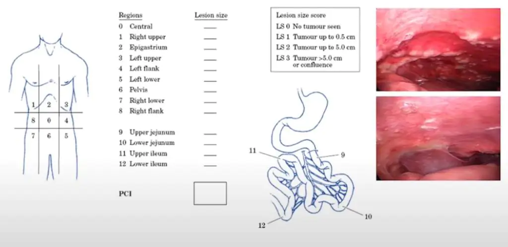 Medmost | Лечение канцероматоза в Корее методом HIPEC и LHIPEC PCI – перитонеальный индекс рака