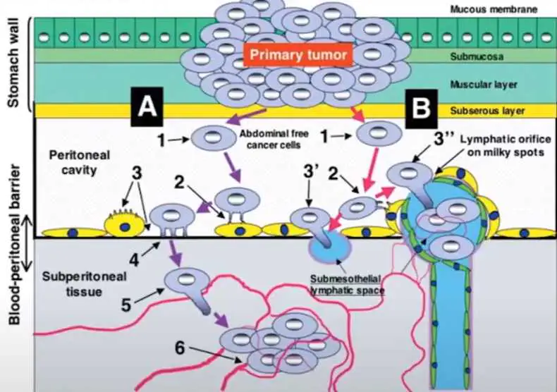 Medmost | Лечение канцероматоза в Корее методом HIPEC и LHIPEC Перитонеальная диссеминация происходит с помощью двух разных процессов