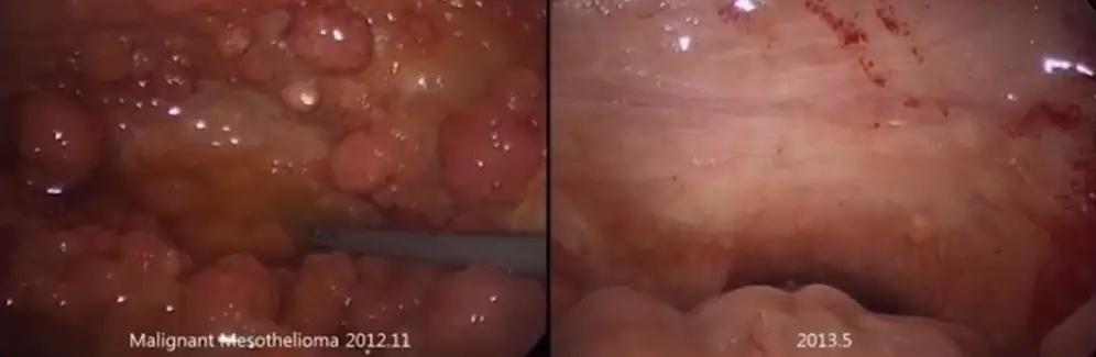 Medmost | Лечение канцероматоза в Корее методом HIPEC и LHIPEC Результаты лечения злокачественной мезотелиомы