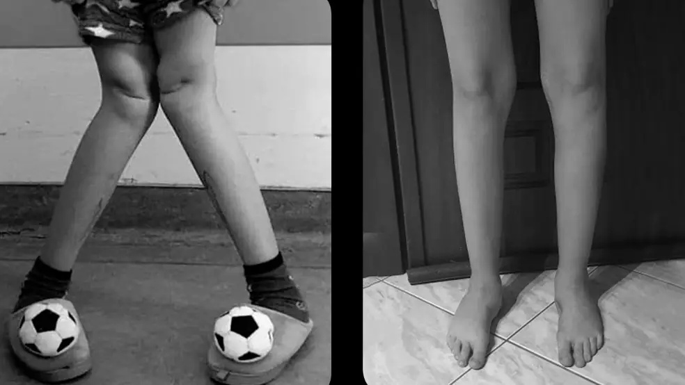 Medmost | Детский ортопед-хирург Профессор Николаос Ригопулос, клиника св. Луки, Салоники, Греция результат после операции доктора Риголопуса