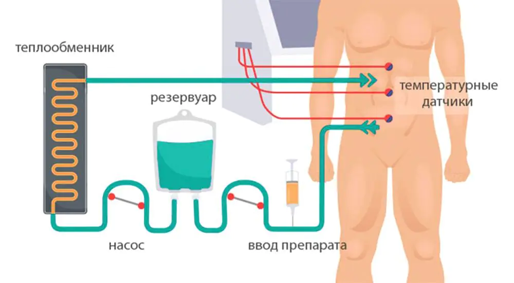 Medmost | Лечение канцероматоза в Корее методом HIPEC и LHIPEC Схема проведения HIPEC