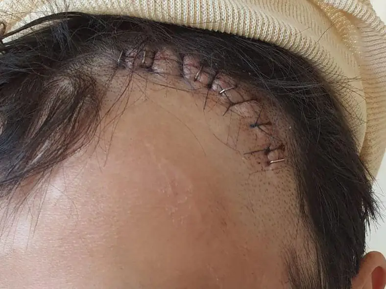 Medmost | Отзыв пациента: лечение опухоли головного мозга в Корее Шрам сразу после операции. Швы накладывают специальным хирургическим степлером, который минимально травмирует кожу