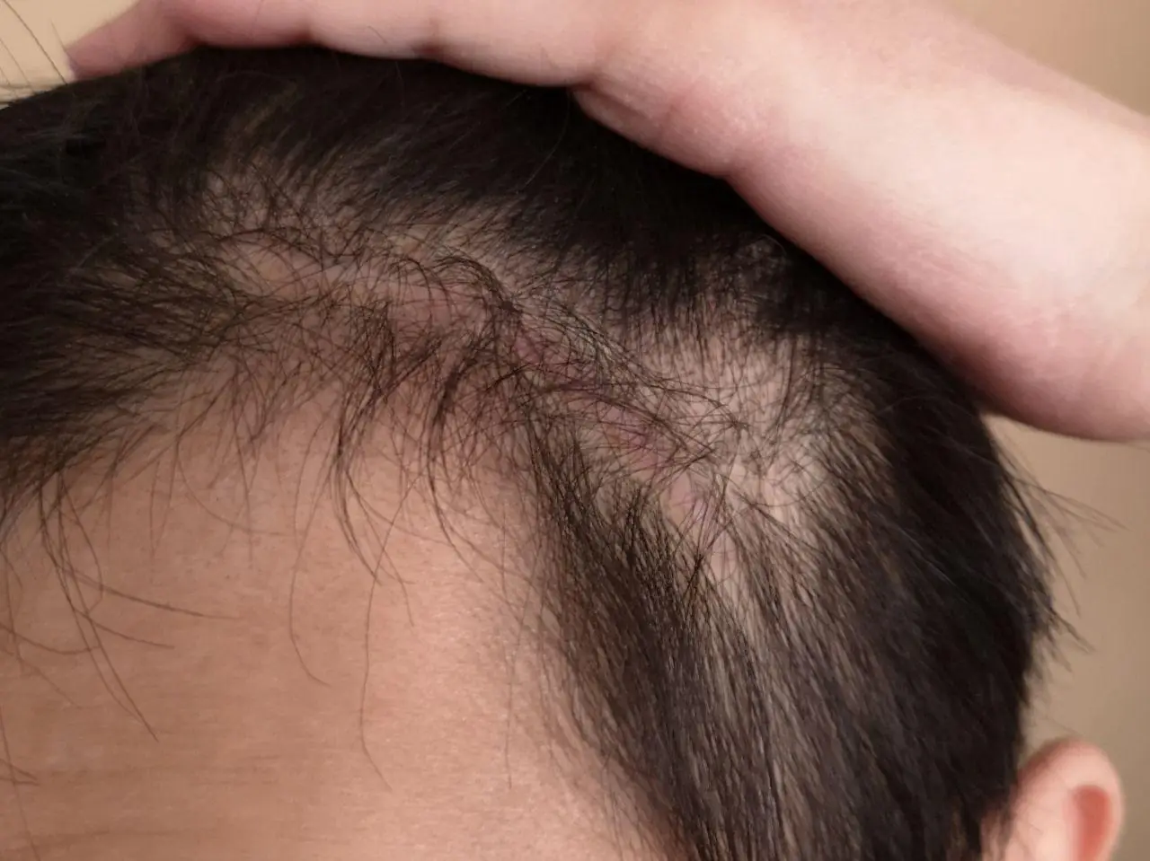 Medmost | Отзыв пациента: лечение опухоли головного мозга в Корее А это я уже через 5 месяцев — на лбу ничего не видно