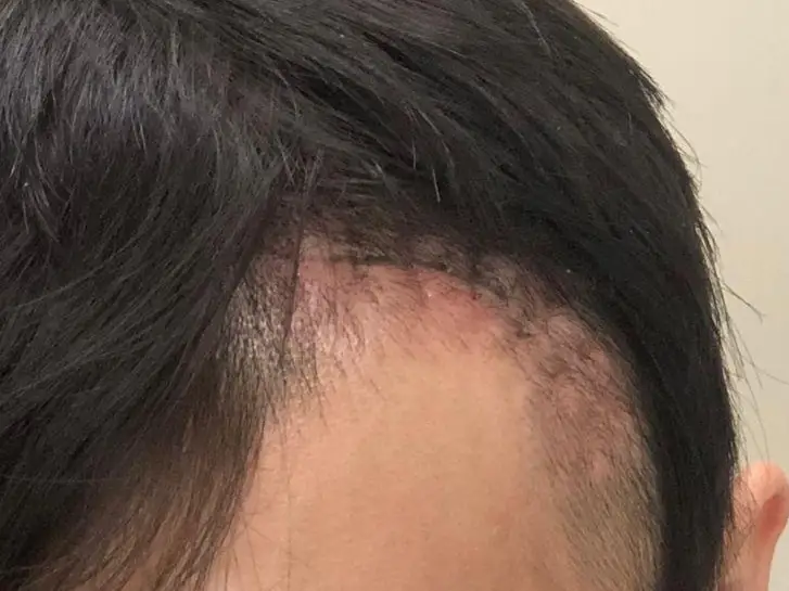 Medmost | Отзыв пациента: лечение опухоли головного мозга в Корее Шрам после снятия швов — уже не так страшно