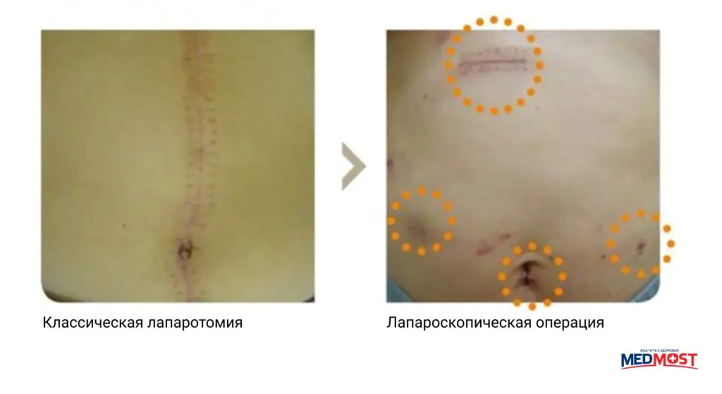Medmost | Лечение рака желудка в Южной Корее Сранение видов операции при раке желудка