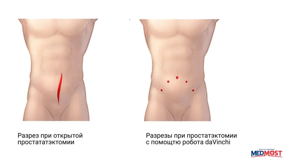 Medmost | Отзыв пациента об удалении рака простаты роботом daVinci Сравнение швов при раке простаты