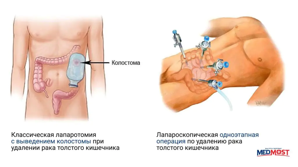 Medmost | Лечение колоректального рака в Южной Корее (рака толстой и прямой кишки) сравнений операций при раке кишечника