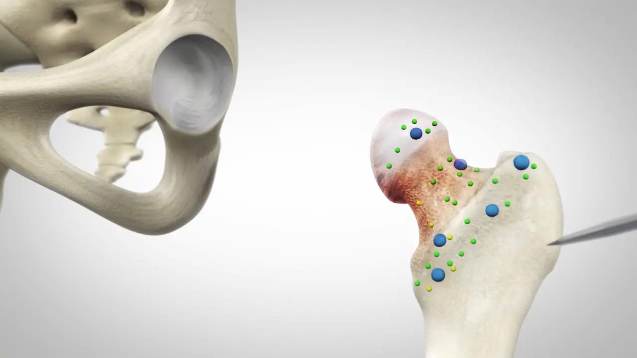 Эндопротезирование тазобедренного сустава за границей: выбор больницы и стоимость лечения